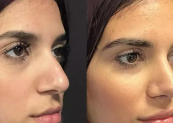 Exploring Rhinoplasty Trends in Dubai