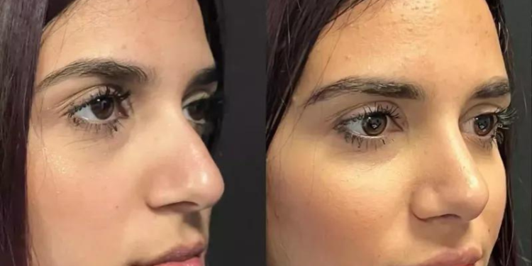 Exploring Rhinoplasty Trends in Dubai