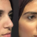 Exploring Rhinoplasty Trends in Dubai