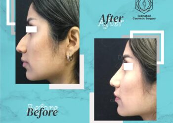 Cosmetic surgery Islamabad