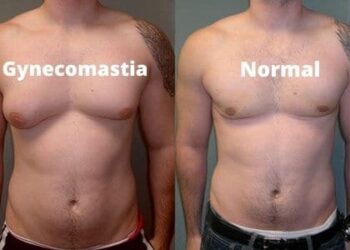 Male chest fat surgery Islamabad