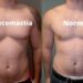 Male chest fat surgery Islamabad