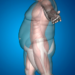What Are the Long-Term Nutritional Challenges After Bariatric Surgery in Dubai
