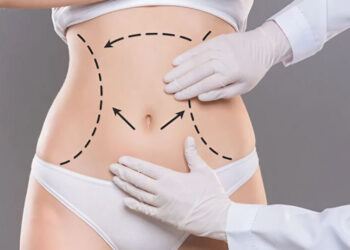 What’s the Recovery Time After Laser Liposuction in Dubai