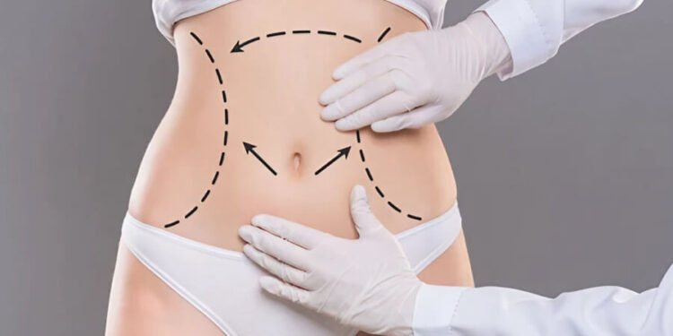 What’s the Recovery Time After Laser Liposuction in Dubai