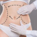 What’s the Recovery Time After Laser Liposuction in Dubai