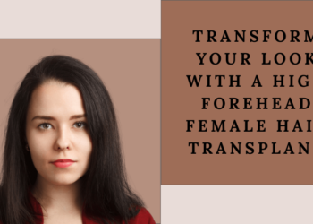 high forehead female hair transplant