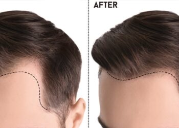 Hair Transplant in Pakistan