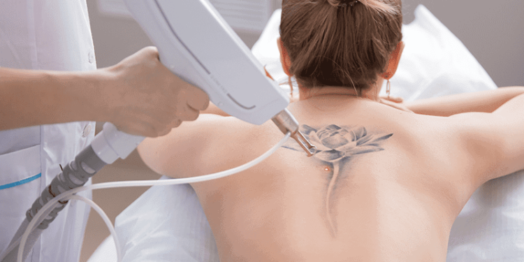 Laser Tattoo Removal How Many Sessions Will You Need