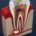 Root Canals