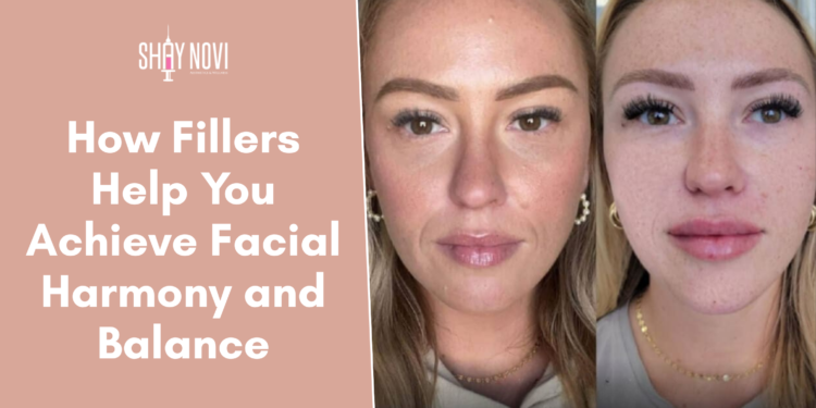 facial balancing with fillers