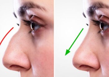 best rhinoplasty in islamabad