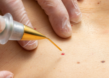 How Salicylic Acid Help in Wart Removal