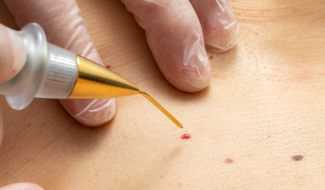 How Salicylic Acid Help in Wart Removal