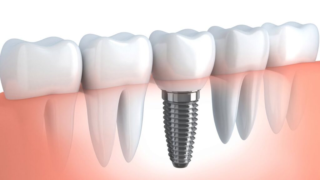 dental implants near me