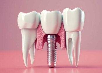 dental implants